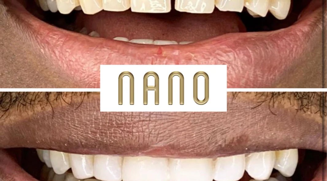 5 Sparkling Benefits of Teeth Whitening - Nano Smile Cosmetics